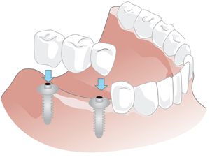 implantatgetragene Brücke 