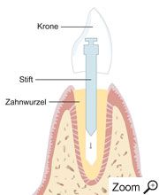 Stiftzahnkrone