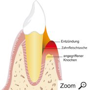 entzündeter Zahn entzündeter Zahn